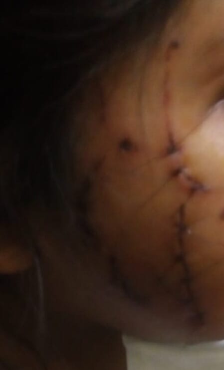 Las heridas que recibió la niña en su cara 